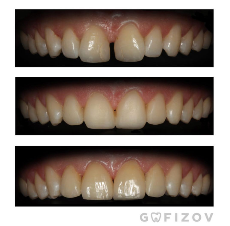 Виниры Emax, устранение диастемы