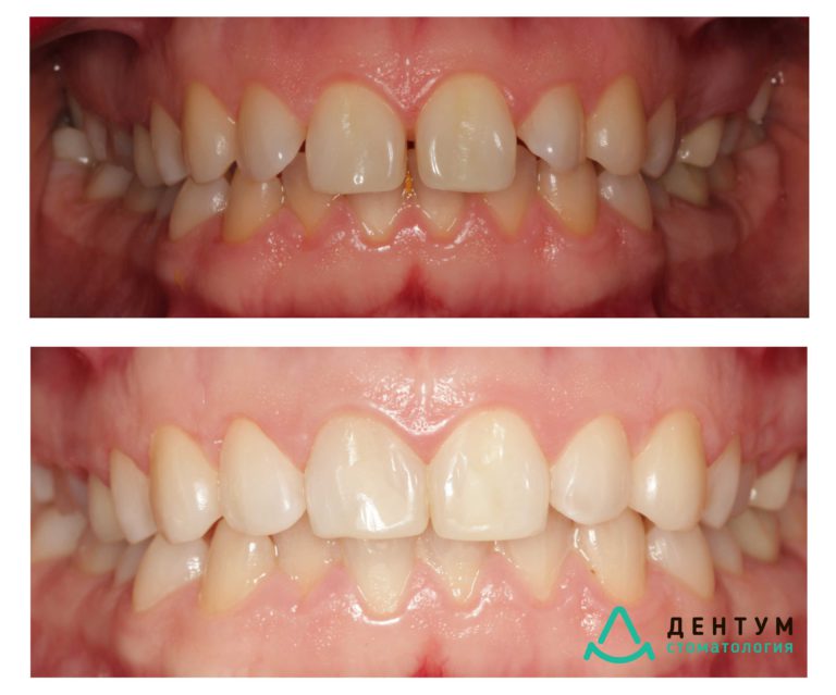 Исправление прикуса каппами 3D smile