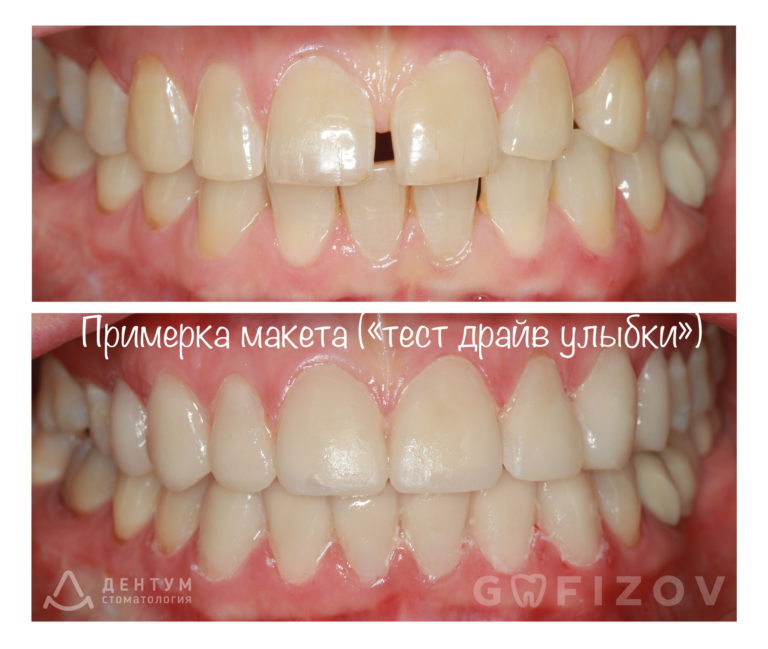 Тест драйв улыбки