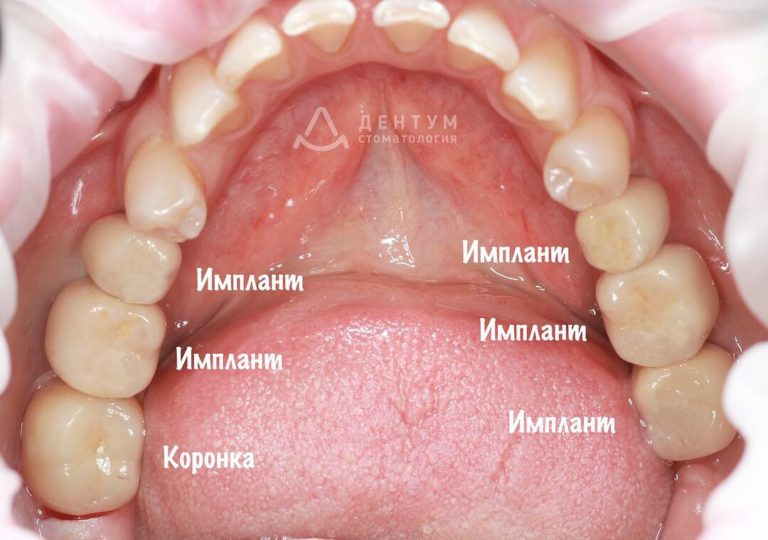 Восстановление жевательных зубов с помощью имплантов и коронок