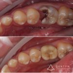 История одной имплантации, фото 1