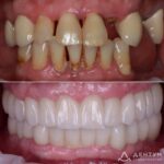 Имплантация + протезирование, фото 1