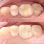 Имплантация + протезирование, фото 1