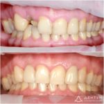 Одномоментная имплантация + протезирование, фото 1