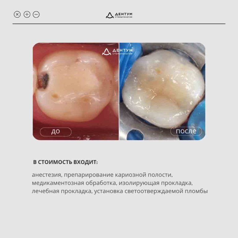 Лечение кариеса и пломбирование