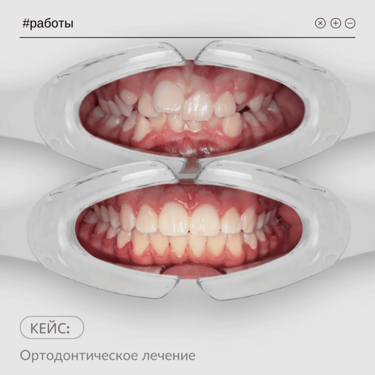 Ортодонтическое лечение