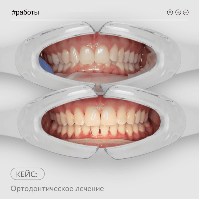 Кейс: исправление прикуса и скученности зубов