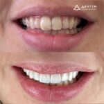 Керамические виниры и коронки, фото 1
