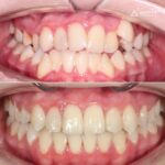 Лечение на брекет-системе Damon, фото 1