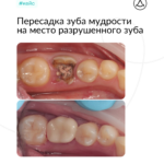 Аутотрансплантация (пересадка) зуба мудрости на место 36 зуба с последующим протезированием, фото 1