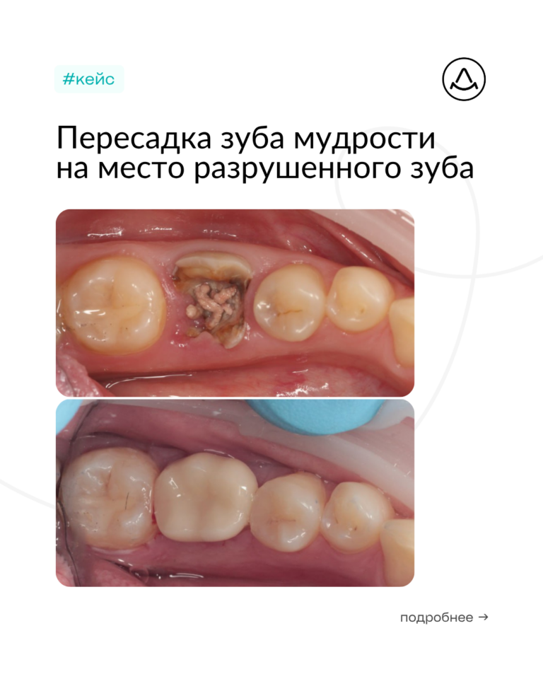 Аутотрансплантация (пересадка) зуба мудрости на место 36 зуба с последующим протезированием