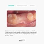 Имплантация Straumann с десневой пластикой и установкой циркониевой коронки, фото 2