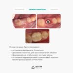 Имплантация Straumann с десневой пластикой и установкой циркониевой коронки, фото 3