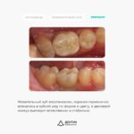 Имплантация Straumann с десневой пластикой и установкой циркониевой коронки, фото 4