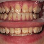 Реставрация зуба 1.2 с учетом флюороза эмали, фото 1