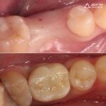 Имплантация Straumann с десневой пластикой и установкой циркониевой коронки, фото 1