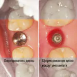 Одномоментная имплантация, фото 2