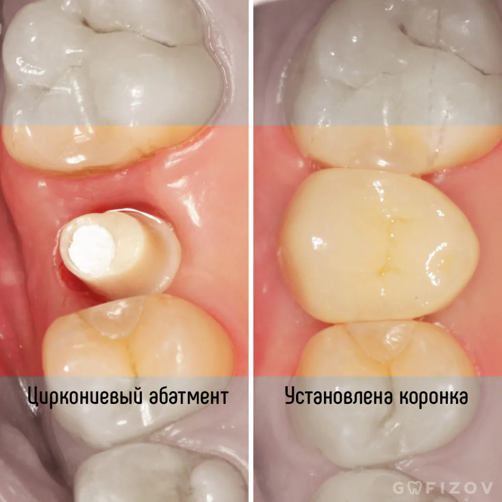 Одномоментная имплантация, фото 3