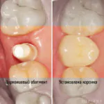 Одномоментная имплантация, фото 3