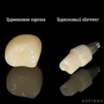 Одномоментная имплантация, фото 4