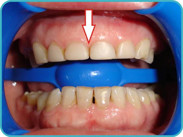 неправильная реставрация зуба