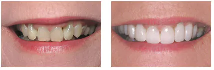 реставрация зубов