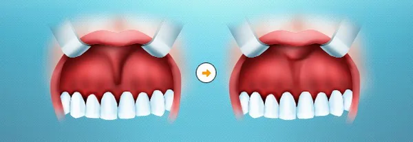 операция пластика уздечки верхней губы