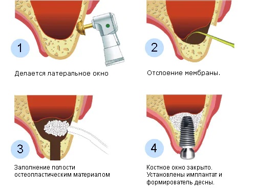 синуслифтинг открытый