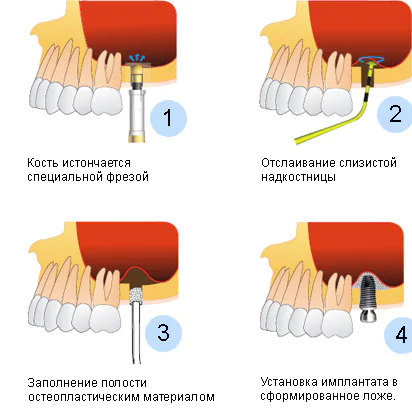 синуслифтинг закрытый