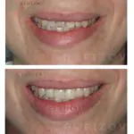 Коррекция улыбки с помощью керамических коронок, фото 1