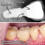 Установка металлокерамической коронки на имплантат, фото 1