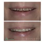 Виниры Emax, фото 1