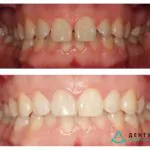 Исправление прикуса каппами 3D smile, фото 1