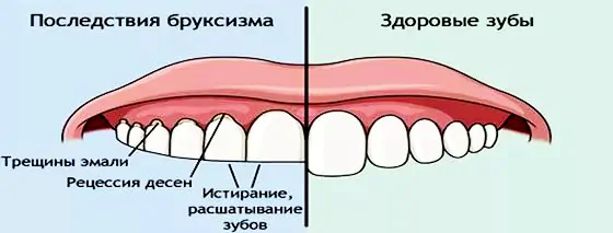 последствия бруксизма