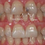 Реставрация CeramX-DUO, фото 1