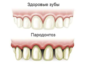 лечение пародонтоза в домашних условиях