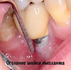 оголение шейки импланта