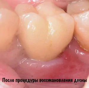 восстановление десны вокруг импланта