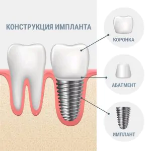 строение импланат схема