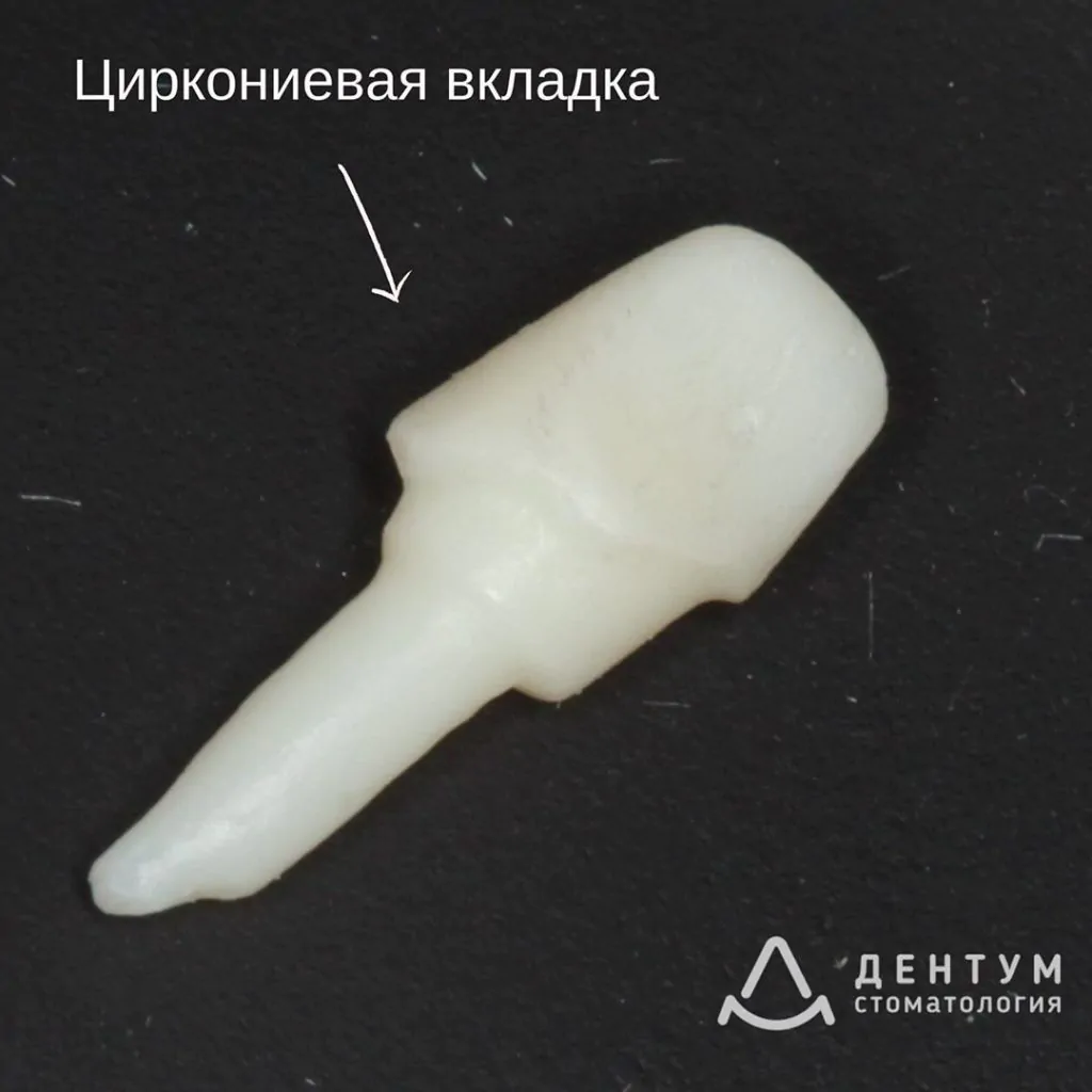 Выпавшая пломба из переднего зуба, фото 2