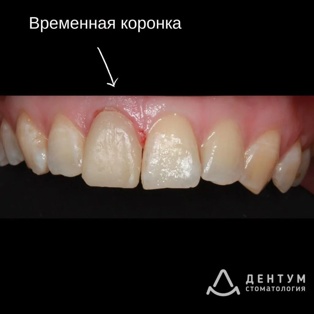 Выпавшая пломба из переднего зуба, фото 3