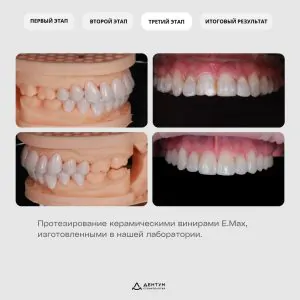 фотопротокол лечения - протезирование