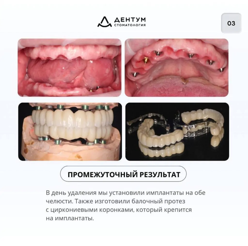 Имплантация + протезирование, фото 4
