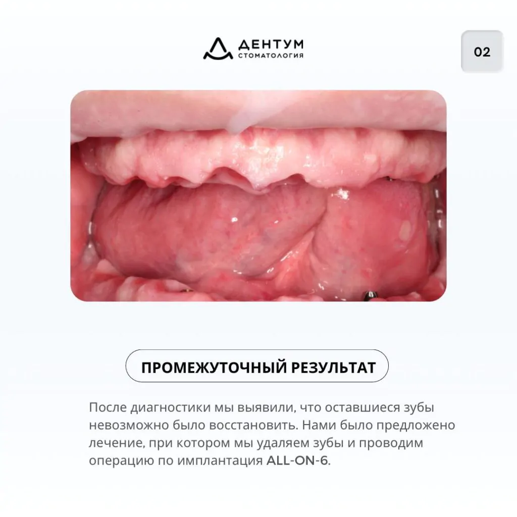 Восстановление жевательной функции и эстетики зубов, фото 3