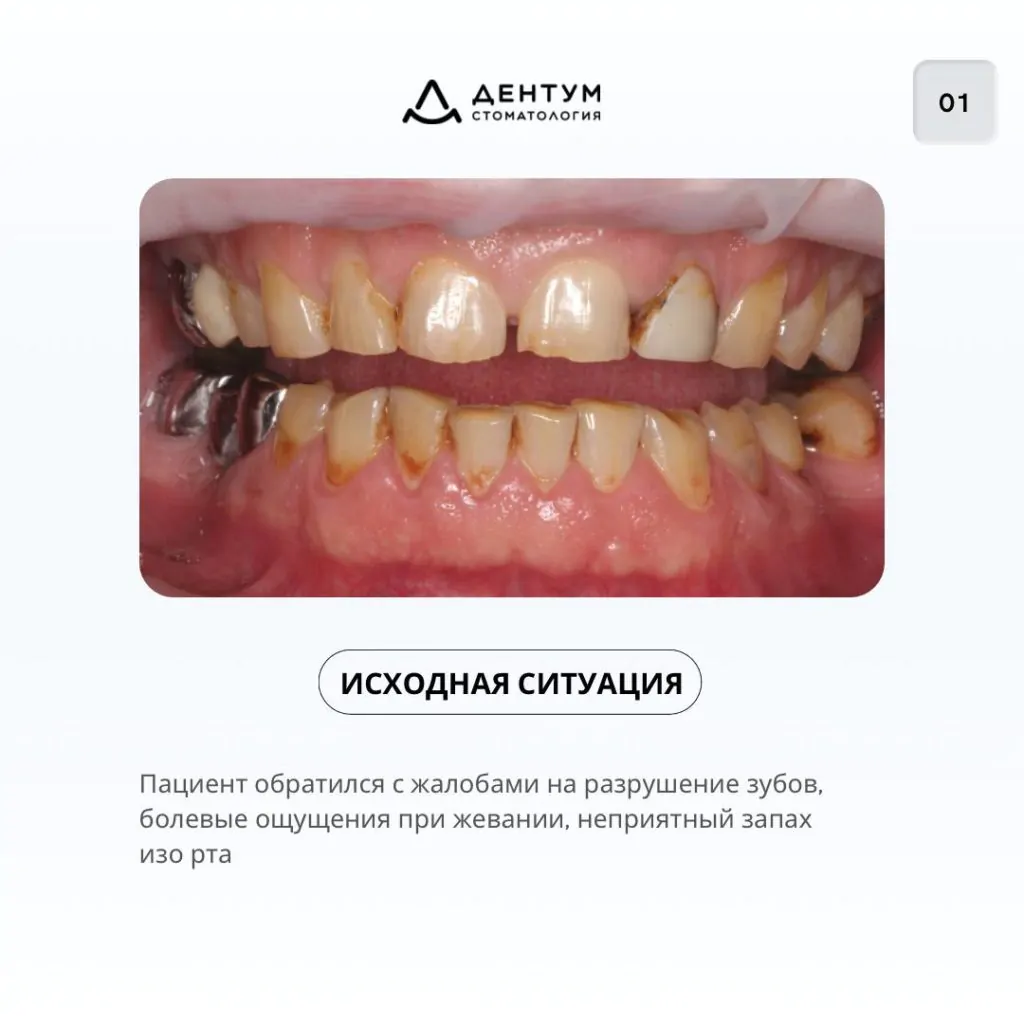 Комплексное лечение по восстановлению зубов, фото 2