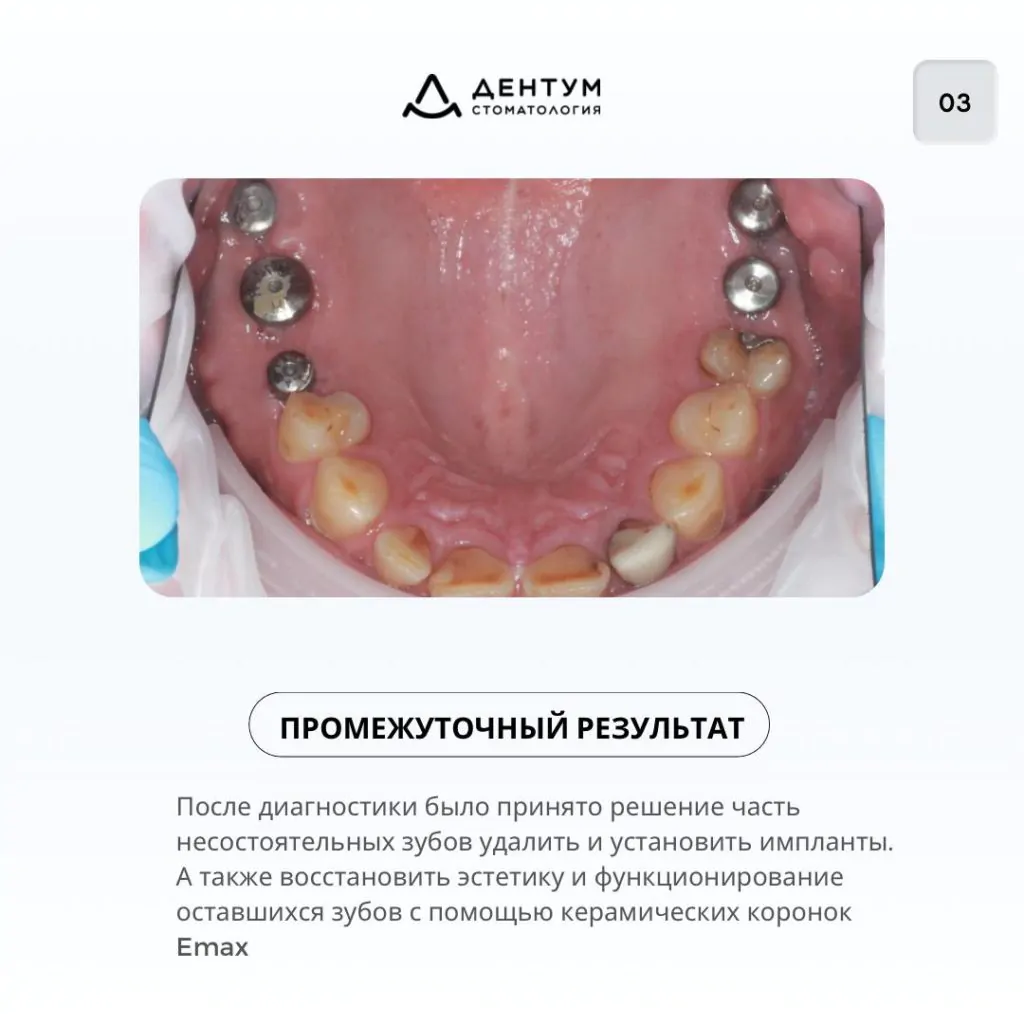 Комплексное лечение по восстановлению зубов, фото 4
