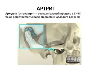Остеоартрит ВНЧС