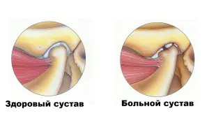Ревматоидный артрит