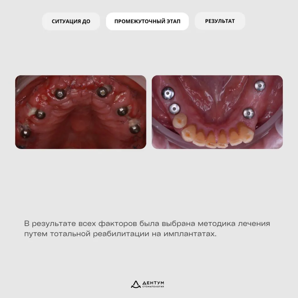 Имплантация «All-on-6», фото 3