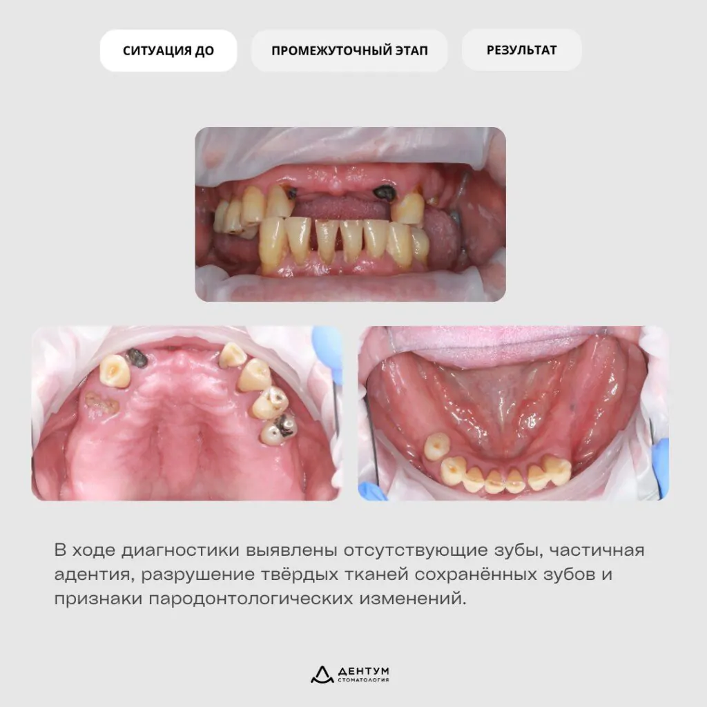 Имплантация «All-on-6», фото 2